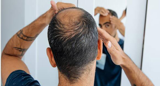 d 2024 Linee guida per la pratica clinica cinese: diagnosi e trattamento dell'alopecia androgenetica