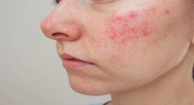 Haziran 2024'te Rosacea İçin Fotodinamik Terapideki Son Gelişmeler