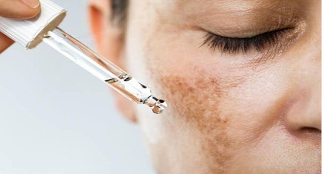 Melatonin: A Promising Treatment for Melasma? New Clinical Evidence Revealed 2024