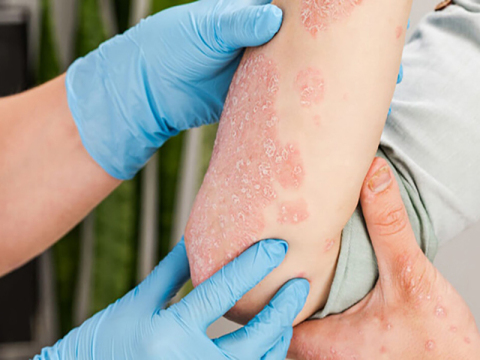 What is psoriasis?