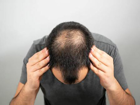 Hair Loss and treatment