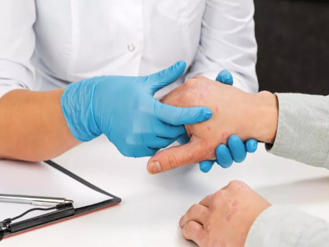 Eczema and how to treat