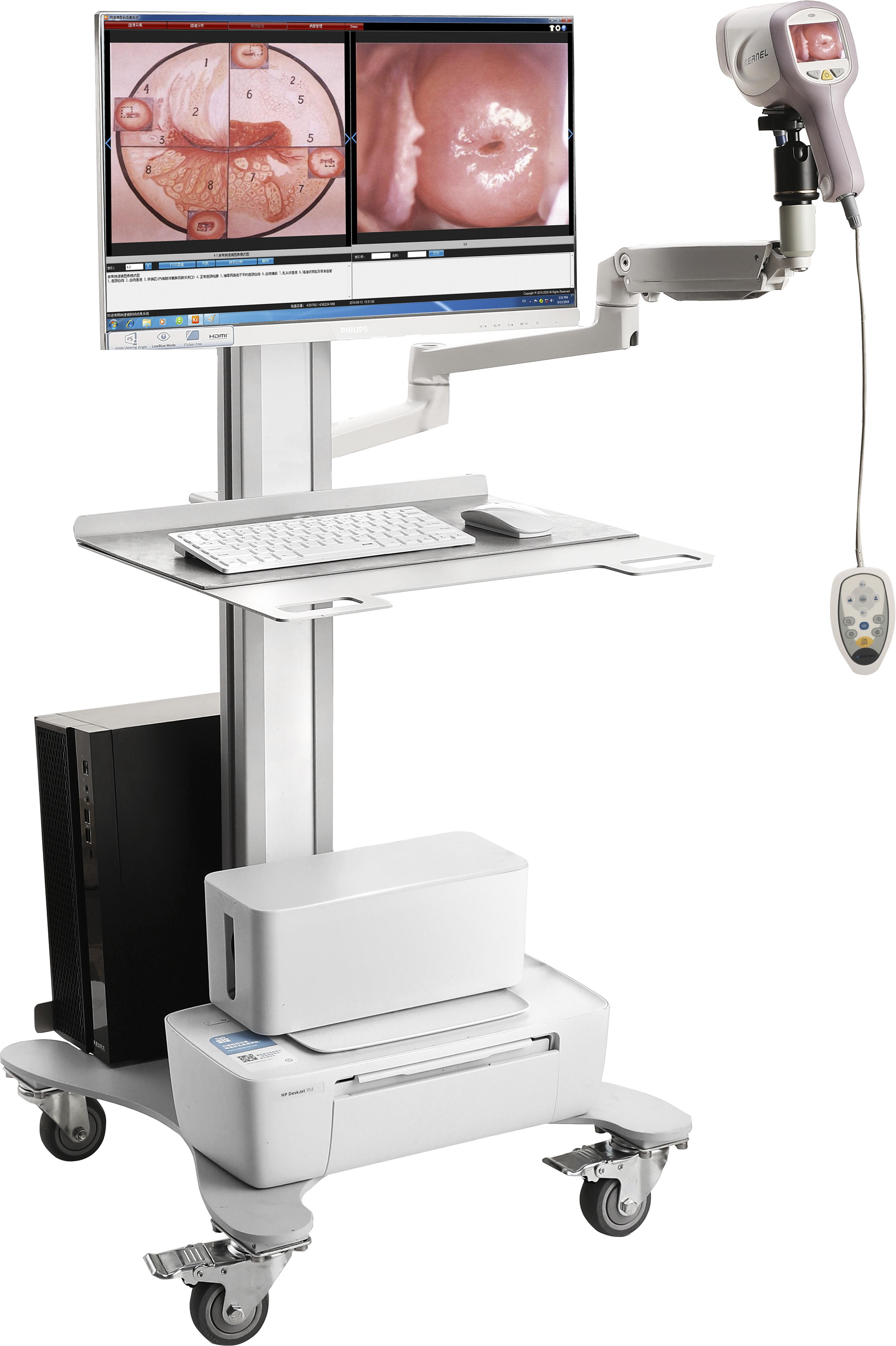 colposcopy biopsy