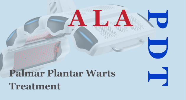 Lancet Özel! Randomize Çift Kör Deneme Sonuçları ALA-PDT'nin Dirençli Palmar ve Plantar Siğillere Karşı Çığır Açan Bir Tedavi Olduğunu Ortaya Koydu
