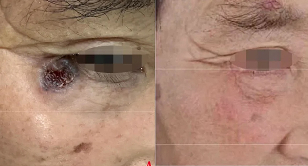 Lorsque la chirurgie seule ne suffit pas : l'ALA-PDT offre une avancée majeure en matière de traitement du carcinome basocellulaire périoculaire sans récidive pendant 23 mois