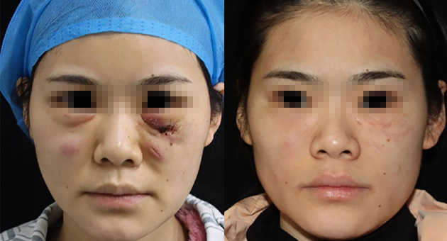 Revolutionary Treatment for Post-Cosmetic Surgery Infections: How ALA-PDT Is Changing the Game for Dermatologists