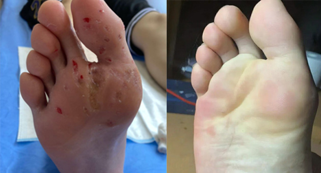 wart treatment