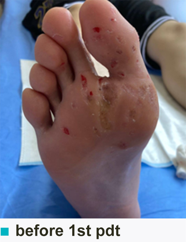plantar warts