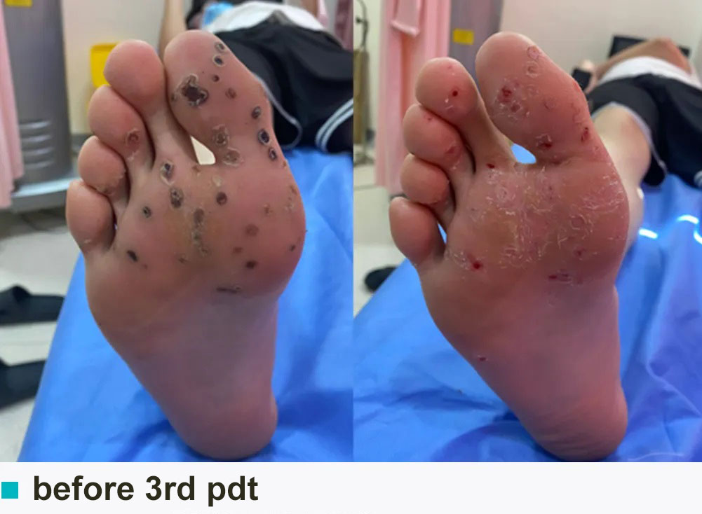 wart treatment