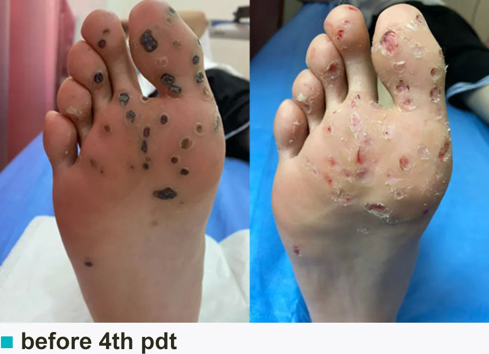 plantar warts