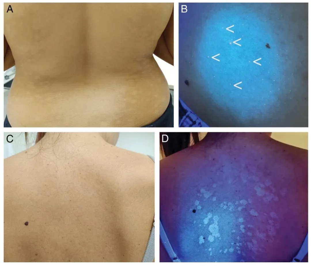 vitiligo diagnosis