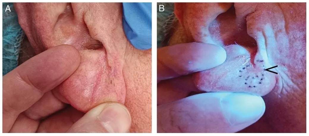 vitiligo diagnosis