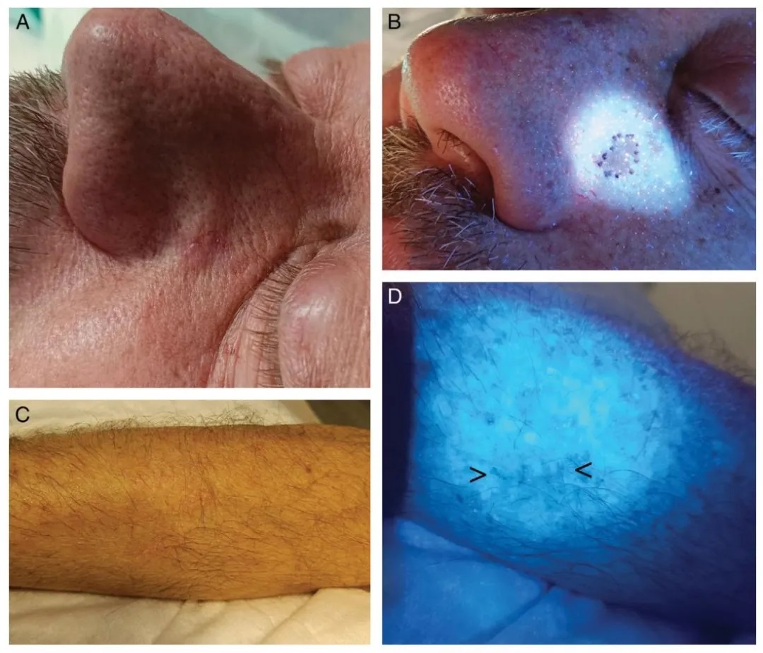 pigmentary disorders