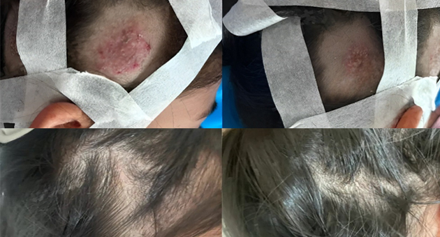 Bir Çocukta Tinea Capitis'in Çift Yaklaşımlı Tedavisi: Fotodinamik Terapi ile Birleştirilen Mikroiğneleme Mükemmel Sonuçlar Veriyor