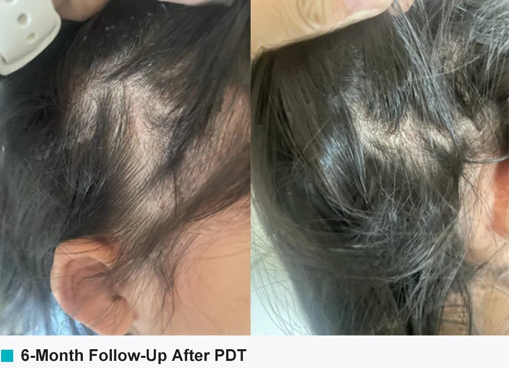photodynamic therapypediatric dermatology