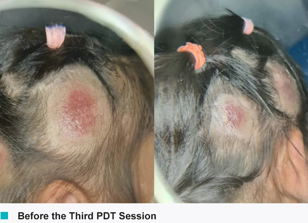 tinea capitis in children