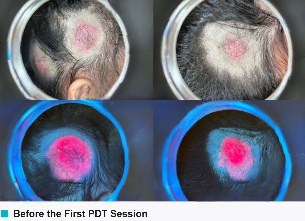 photodynamic therapypediatric dermatology