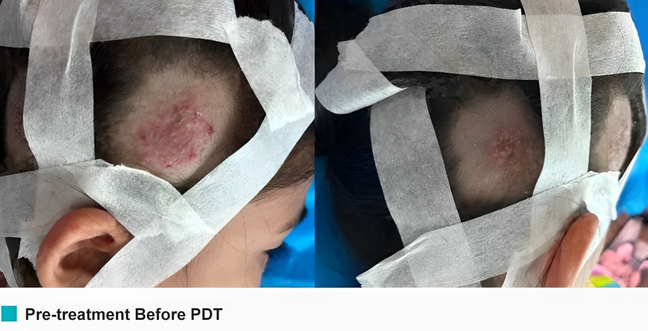 tinea capitis in children
