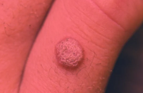 ALA‑PDT vs Placebo: Breakthrough Success in Treating Recalcitrant Hand & Foot Warts