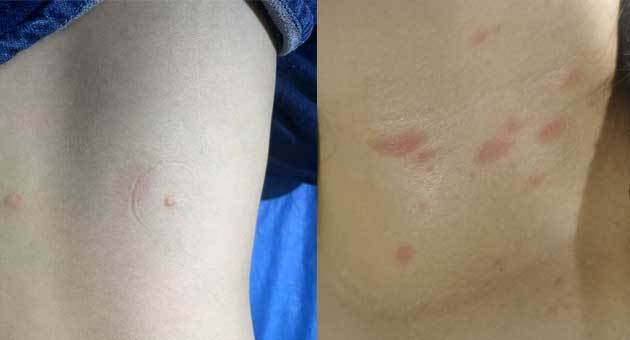 When Skin Diseases Look Alike: How Reflectance Confocal Microscopy Helps Dermatologists Avoid Misdiagnosis Without Biopsy