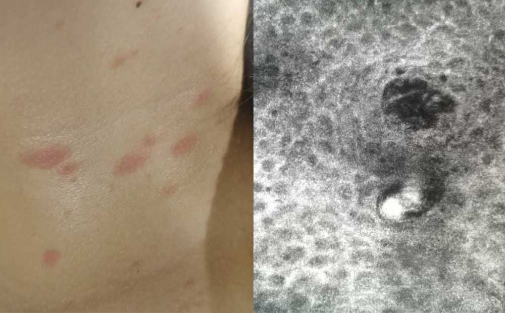 RCM skin imaging diagnosis RCM skin imaging diagnosis