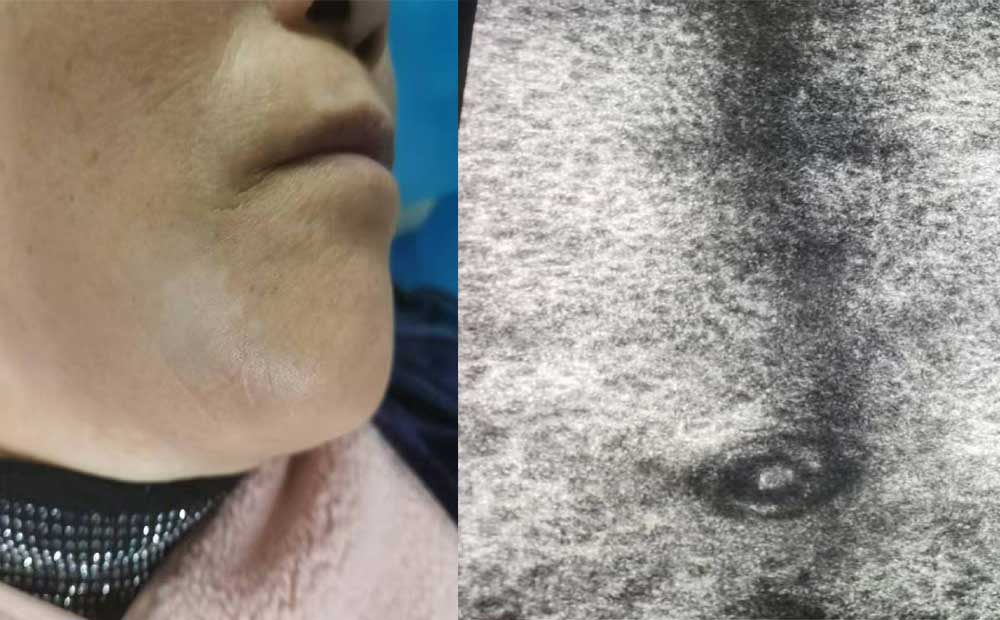 reflectance confocal microscopy dermatology reflectance confocal microscopy dermatology