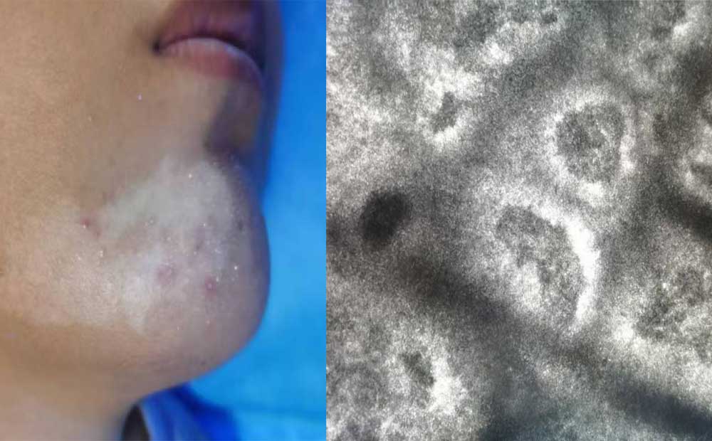 psoriasis vs pityriasis rosea RCM psoriasis vs pityriasis rosea RCM