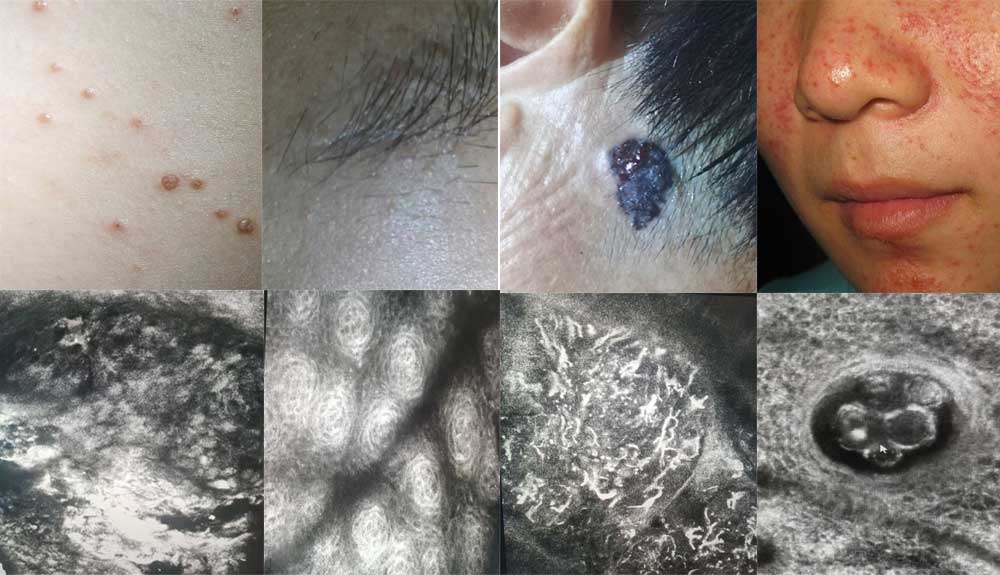 reflectance confocal microscopy dermatology reflectance confocal microscopy dermatology