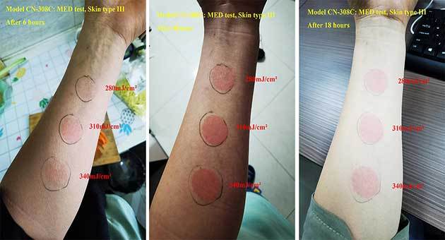 Quando os dados levantam dúvidas: uma verificação interna da MED do sistema de fototerapia LED de 308 nm da KernelMed.