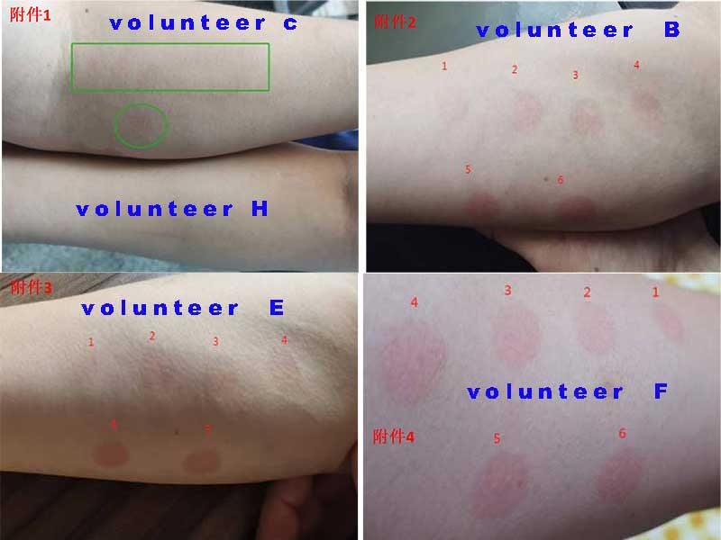 vitiligo phototherapy MED response