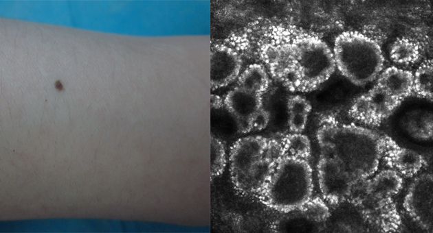 Reflectance Confocal Microscopy (RCM) in Clinical Dermatology: Precision, Applications, and Real-Time Diagnosis