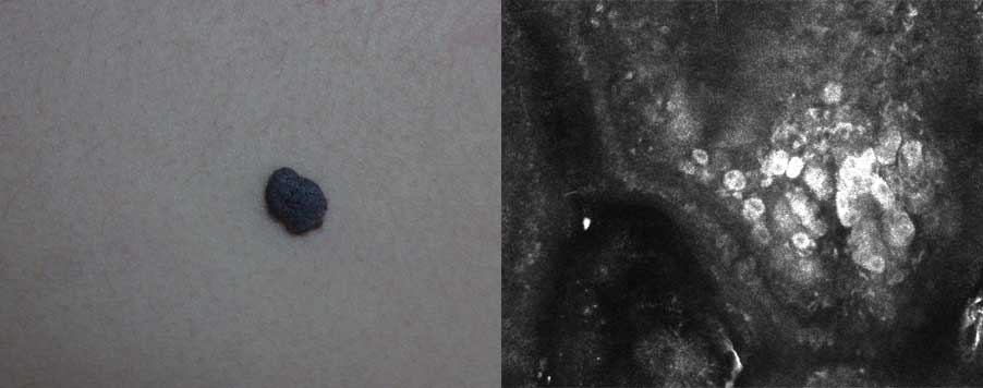 Melasma classification RCM