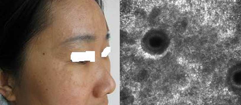 Non-invasive skin diagnosis