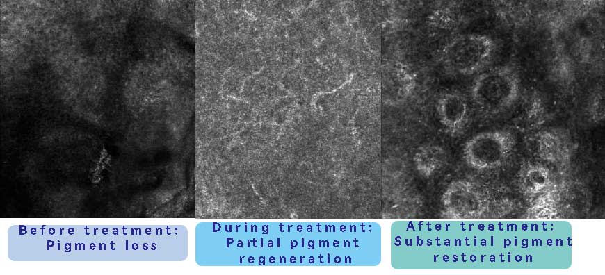 Melasma classification RCM Melasma classification RCM