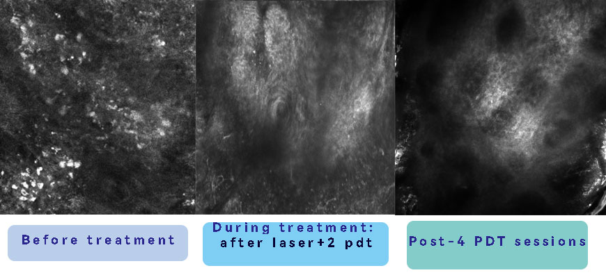 RCM skin imaging RCM skin imaging