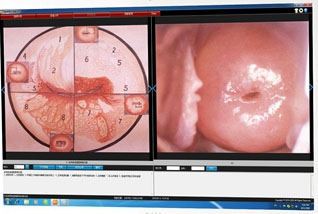 HD Video Colposcope